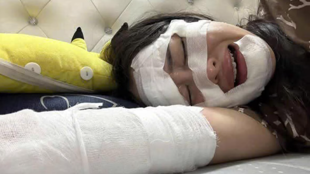 Mujer sufrió graves quemaduras en el rostro al explotar un globo de cumpleaños