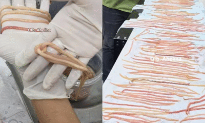 Extraen 142 parásitos de niño de 7 años en Chiapas