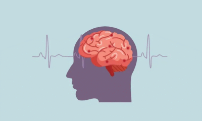 Detectar a tiempo los síntomas del Ictus, fundamental para salvar vidas