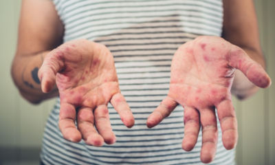 OPS emite alerta epidemiológica por repunte de sarampión en América; urge vacunación