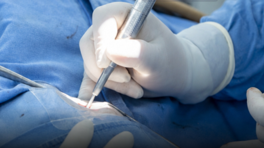 Primer implante coclear bilateral exitoso en el Hospital Juárez